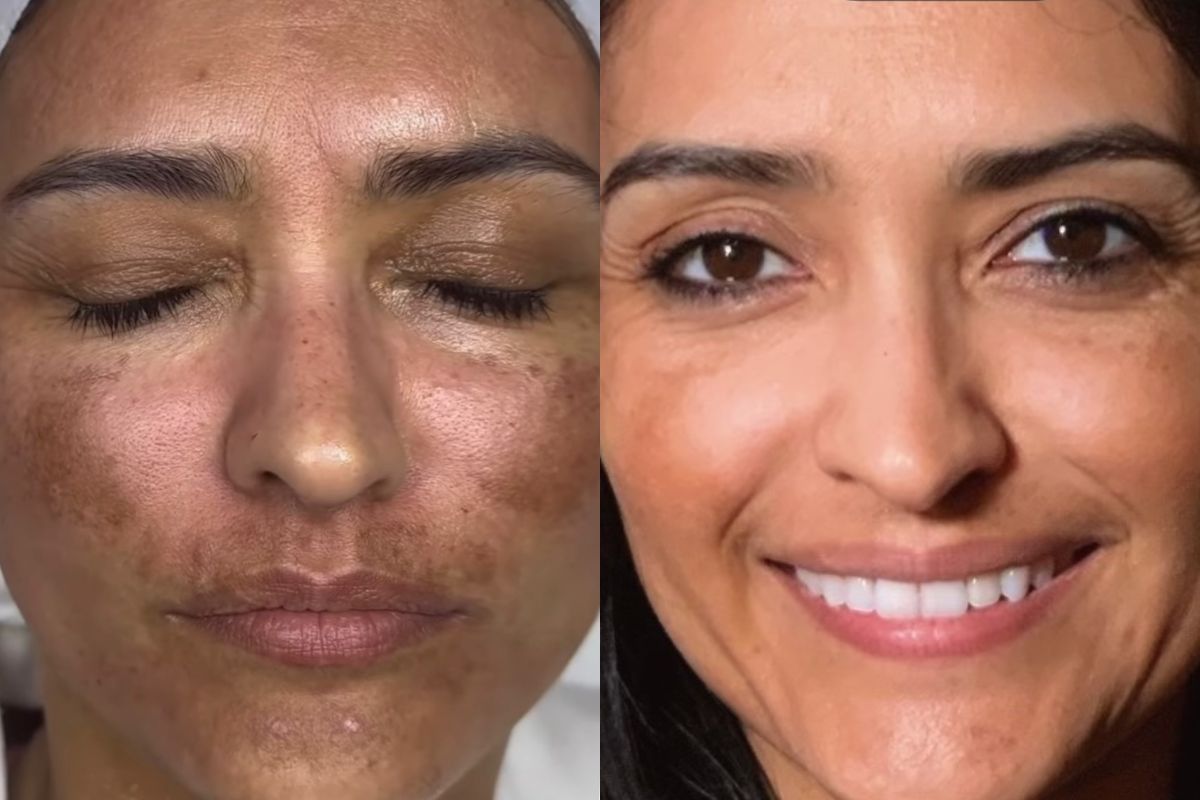 Microneedling before and after