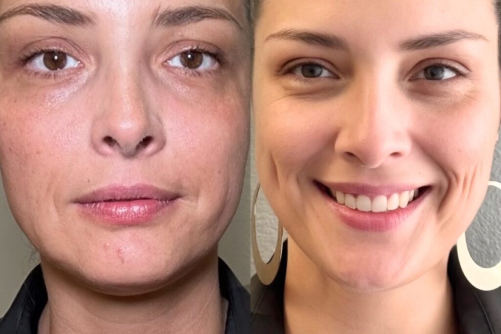 Sculptra before and after