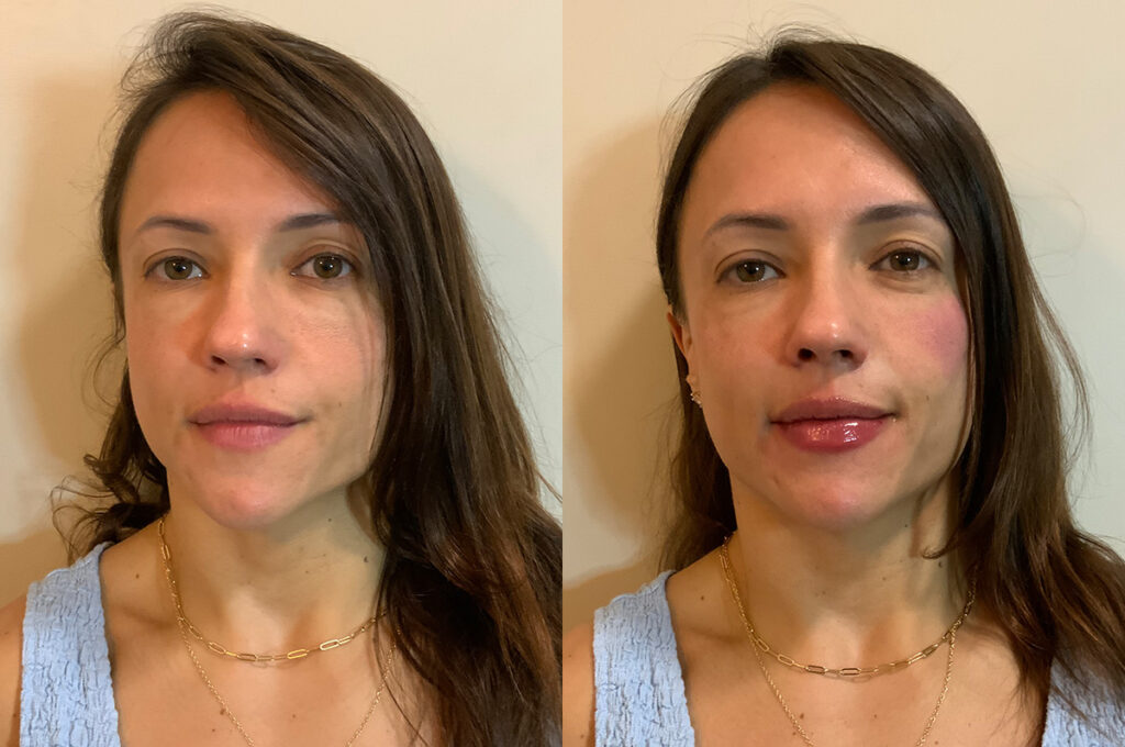 Dermal filler to lips and undereyes before and after