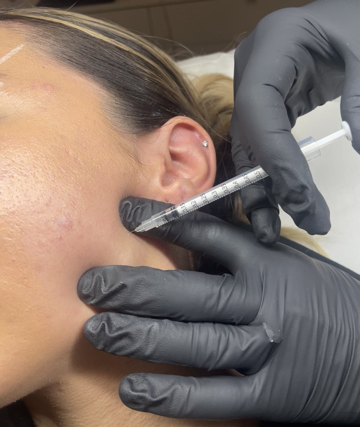 Woman receiving Botox to masseter muscle