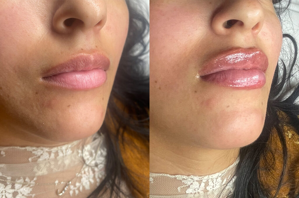 RH3 lip filler before and after