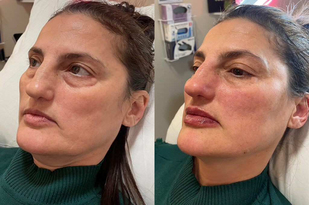 Sculptra full face, and Restylane Kysse lip filler before and after