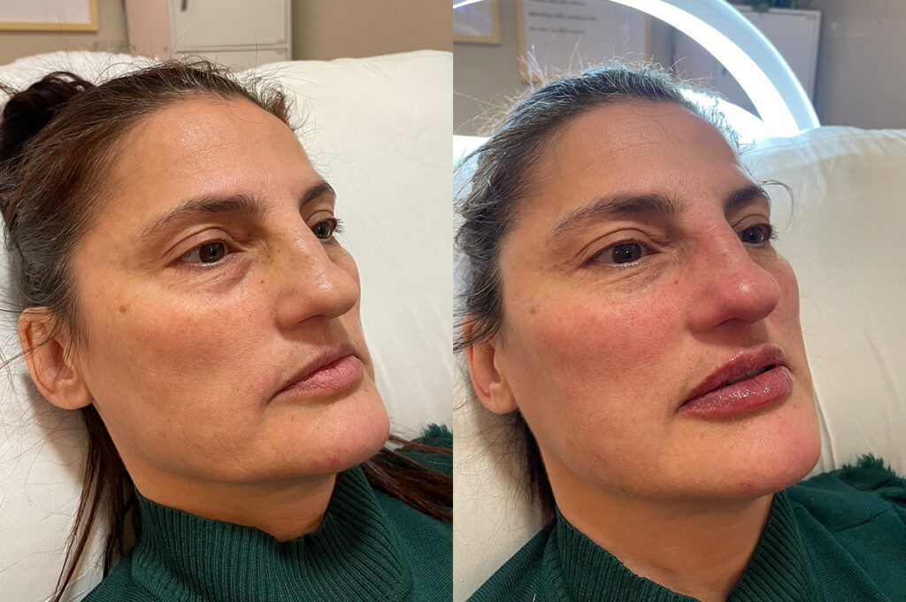 Sculptra full face, and Restylane Kysse lip filler before and after