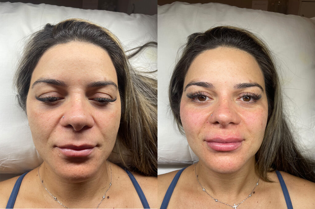 Dermal filler to midface and pyriform aperture before and after