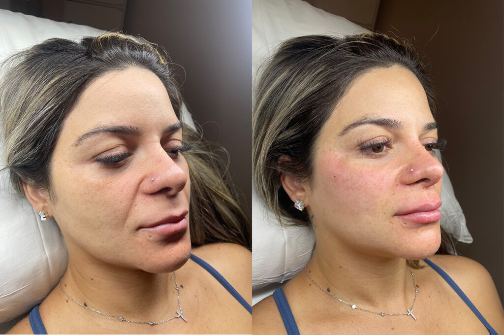 Dermal filler to midface and pyriform aperture before and after