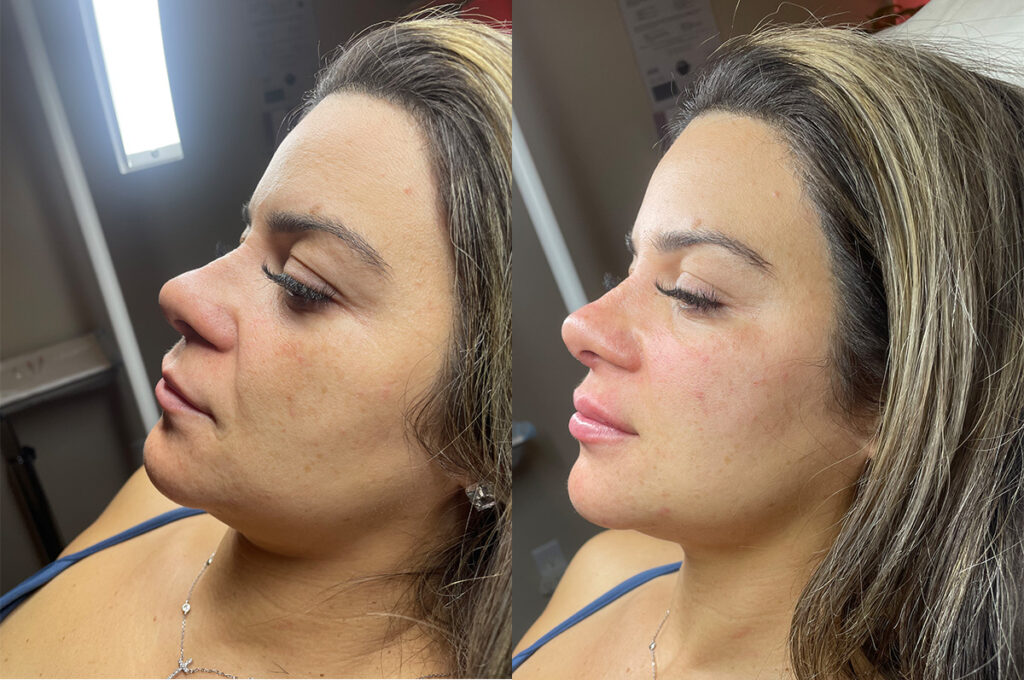 Dermal filler to midface and pyriform aperture before and after