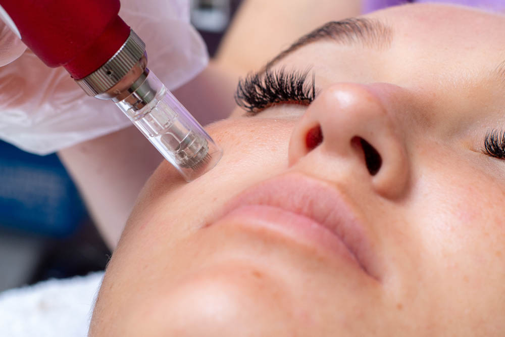 woman receiving microneedling treatment