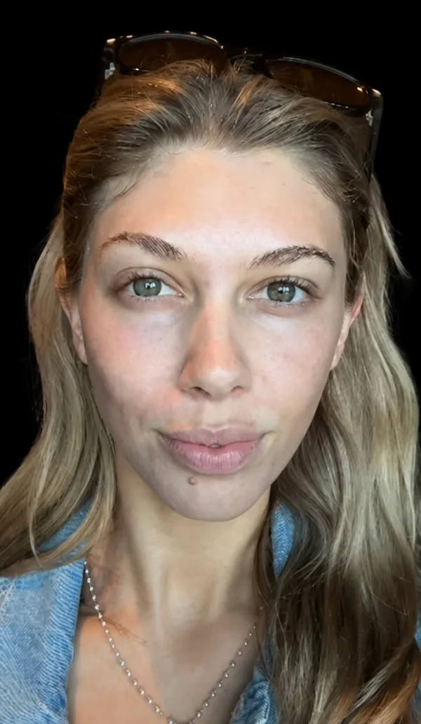 Plexr client 1, before treatment