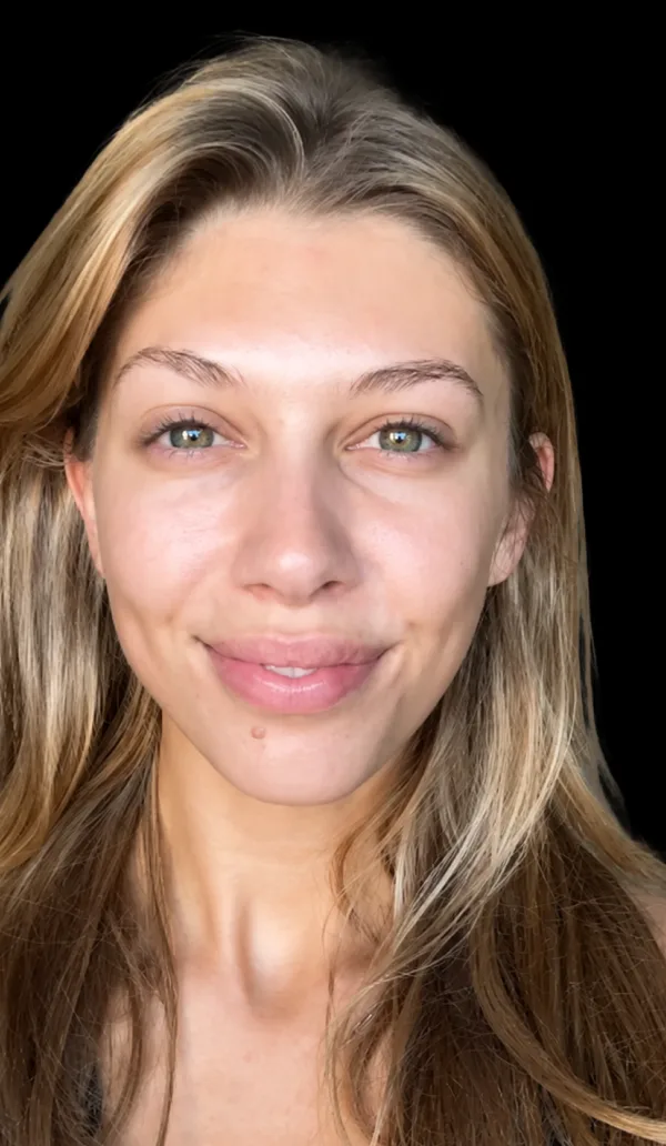 Plexr client 1, after treatment
