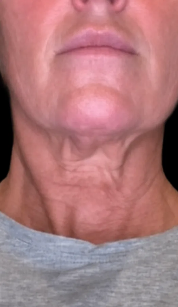 Plexr client 2, before treatment