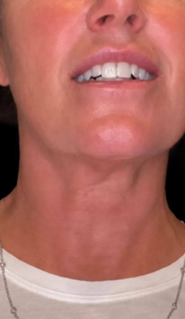 Plexr client 2, after treatment
