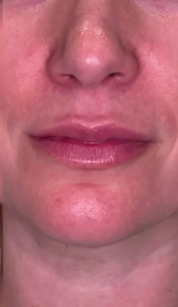 Dermal filler client 1, before treatment
