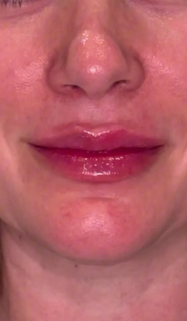 Dermal filler client 1, after treatment