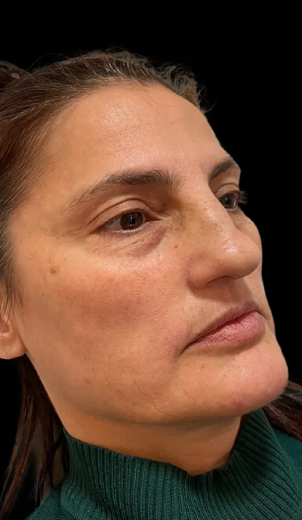 Sculptra client 1, before treatment