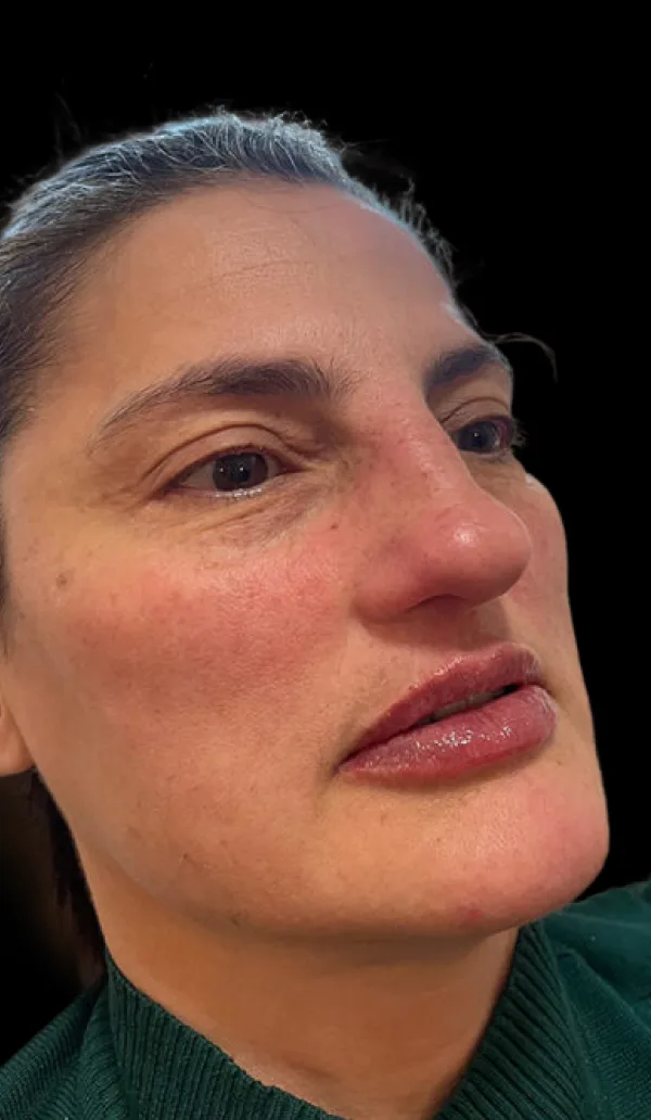 Sculptra client 1, after treatment