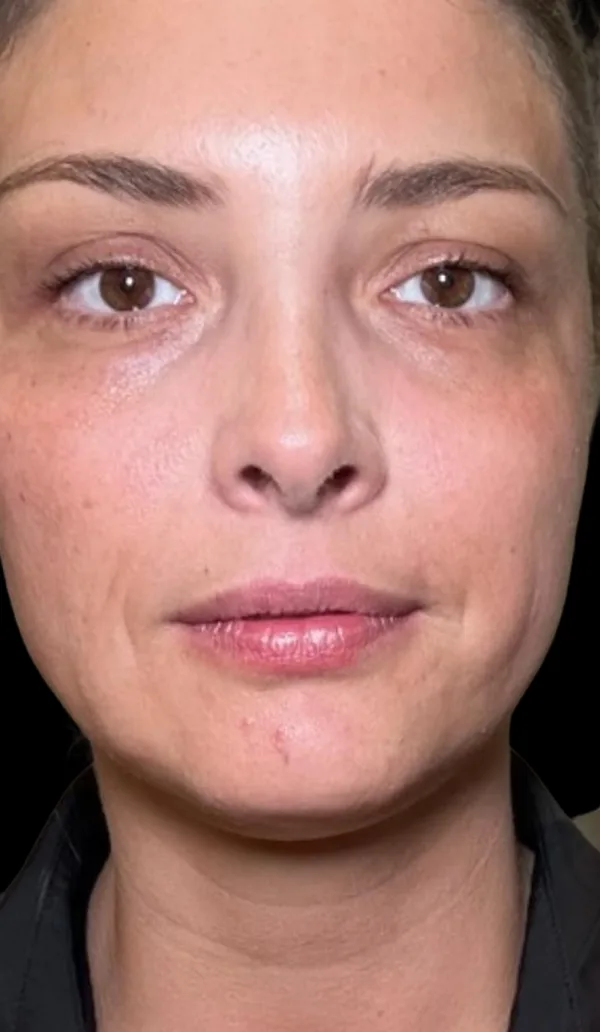 Sculptra client 2, before treatment