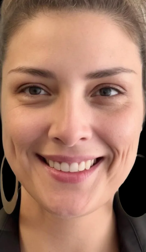 Sculptra client 2, after treatment