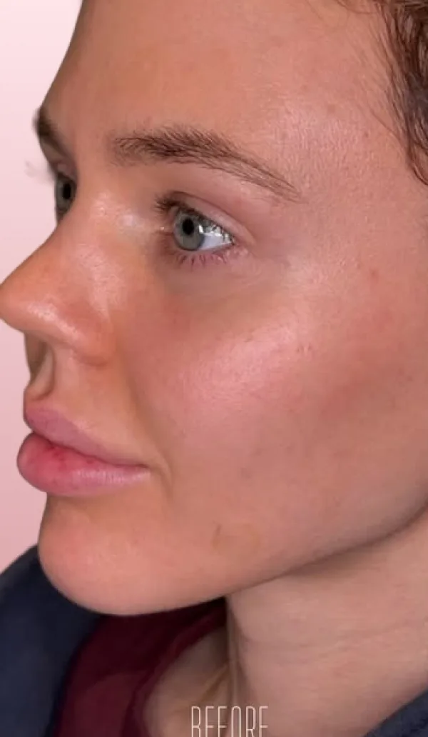 Dermal filler client 2, before treatment