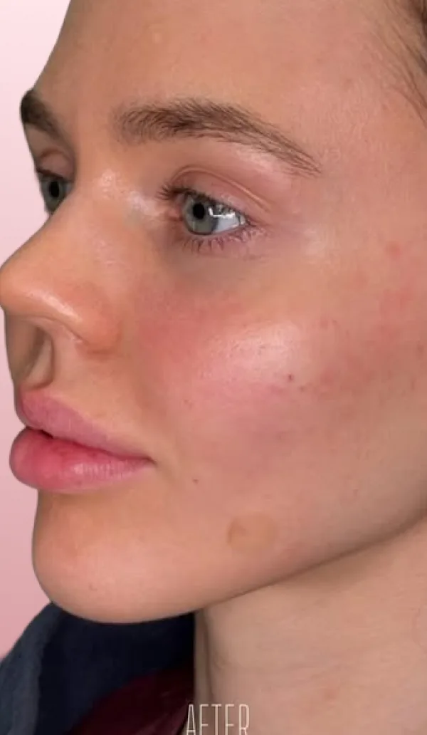 Dermal filler client 2, after treatment