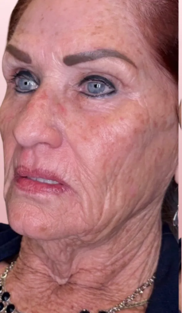Sofwave client 1, before treatment