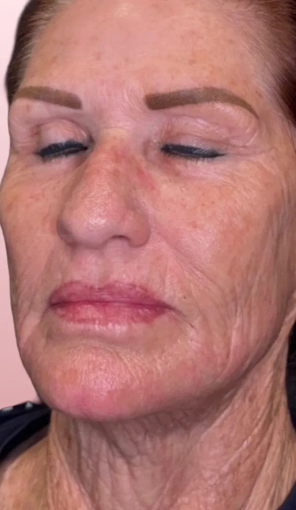 Sofwave client 1, after treatment